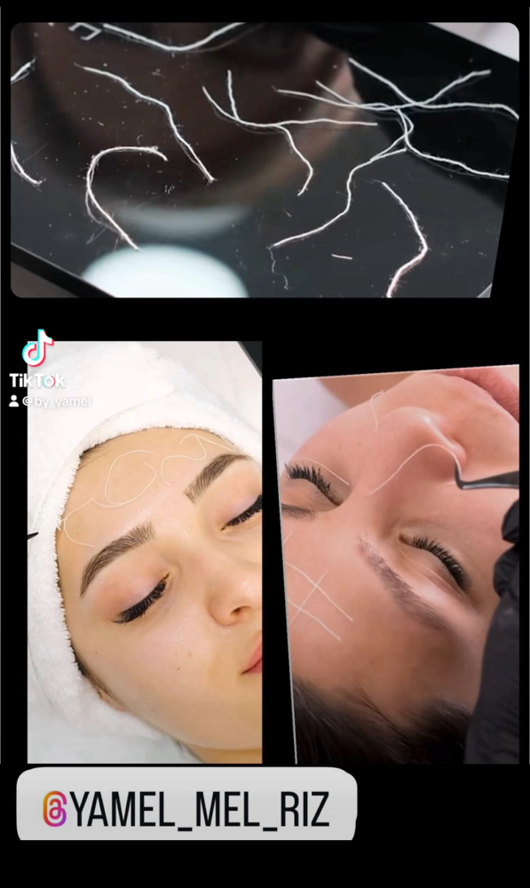 Non-Invasive Collagen Threads Facial