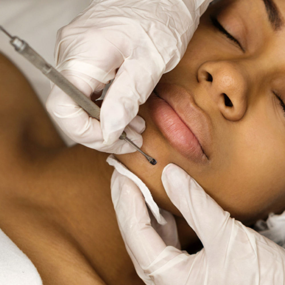 Acne Facial at Volimé Esthetics in Haslett, MI