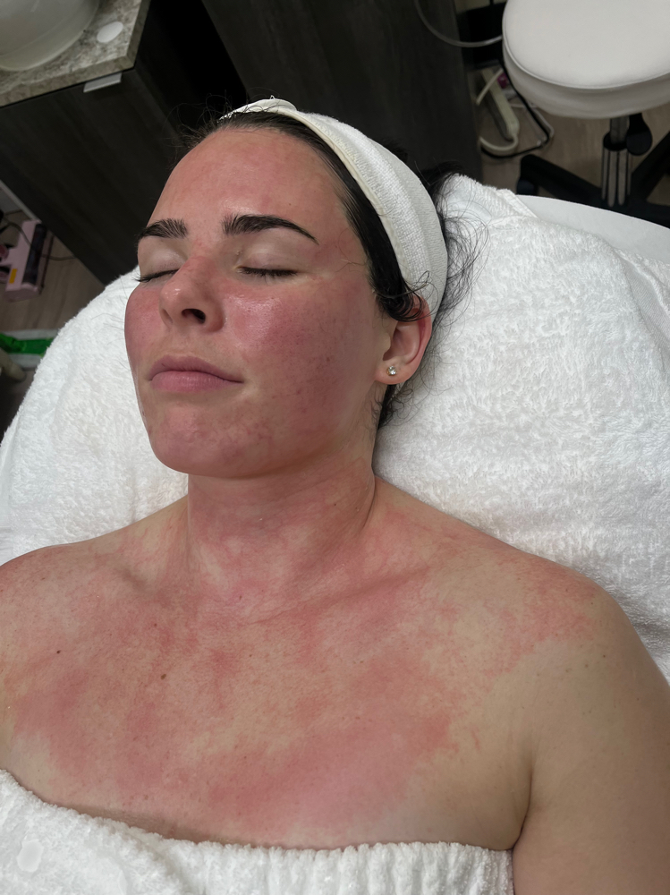 Microneedling + DMK Enzyme