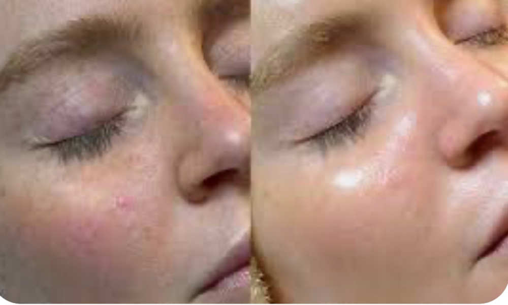 Microneedling