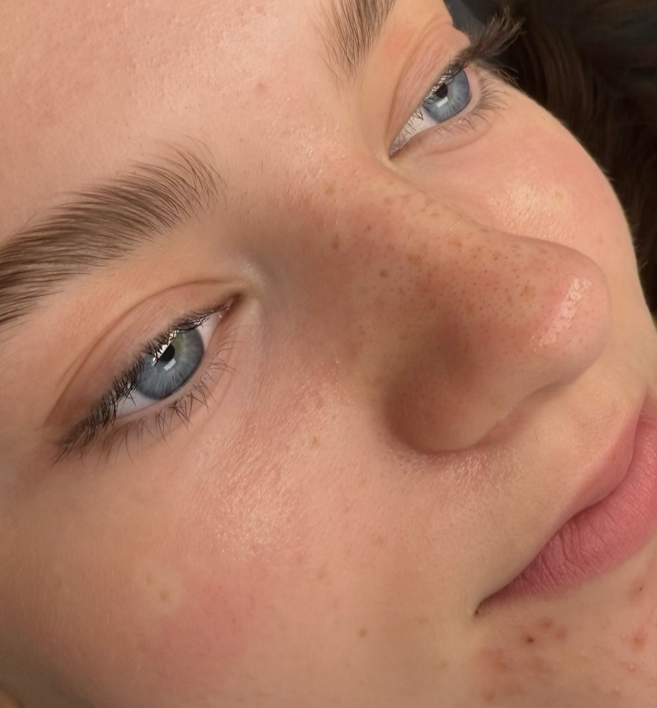 Freckle Tattoo Touch Up