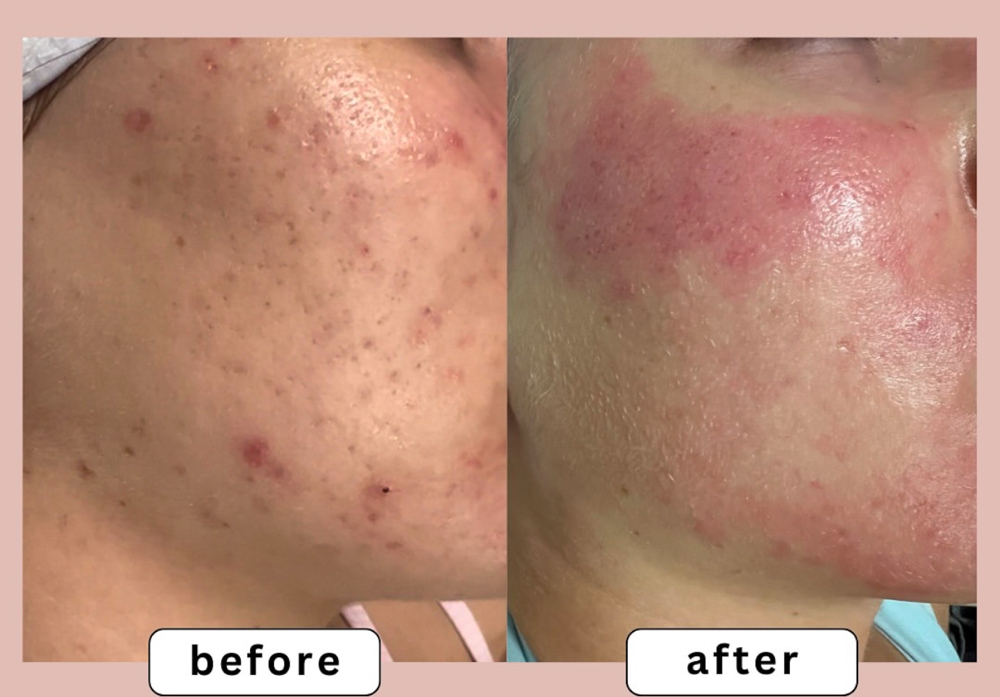 POST🐚ACNE/SCARS🥥M/NEEDLING+