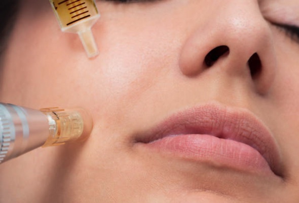 Microneedling PRP