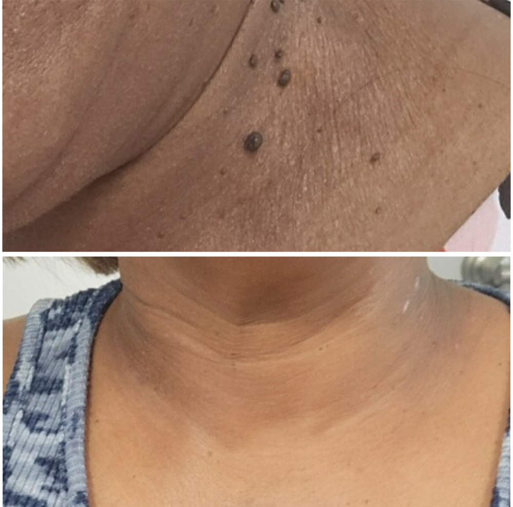 DPN/Skin Tag Removal 30-60