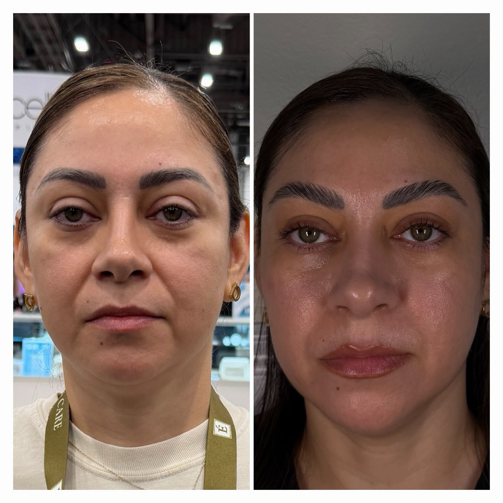 EXOPEEL (1 Session) at Fountain of Youth Spa in Yuma, AZ