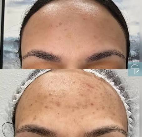 Plasma Pigment Removal Treatment