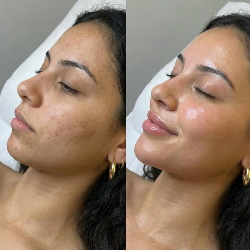 Microneedling at Amethyst Spa in Omaha, NE