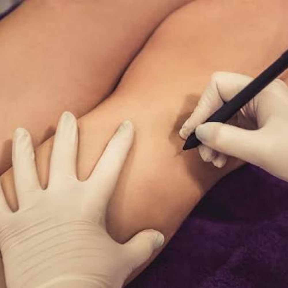 Electrolysis Treatment | 90 Minutes at Elite Electrology in Medford, WI