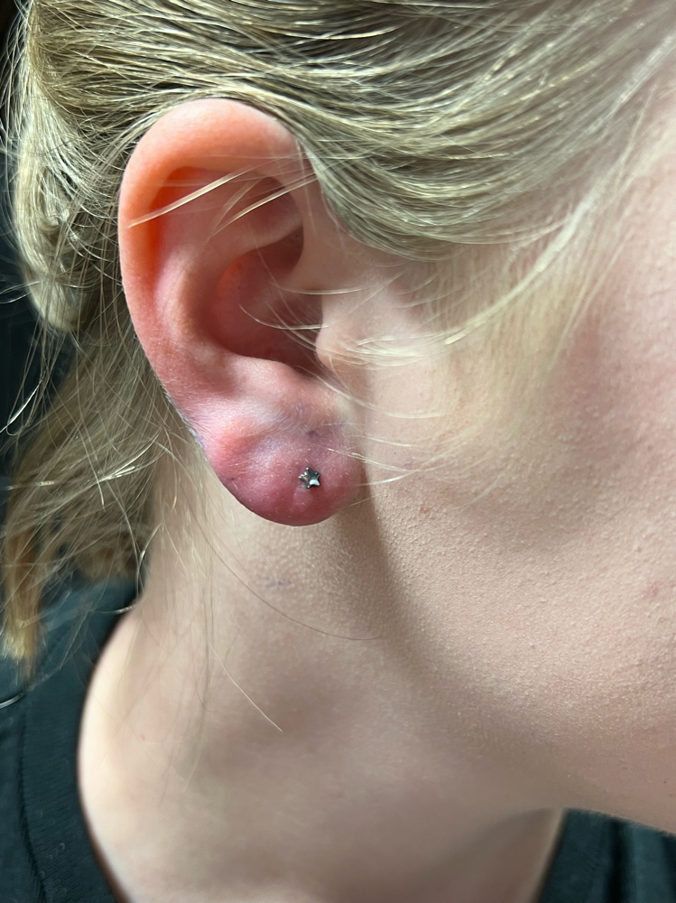 Both Lobes