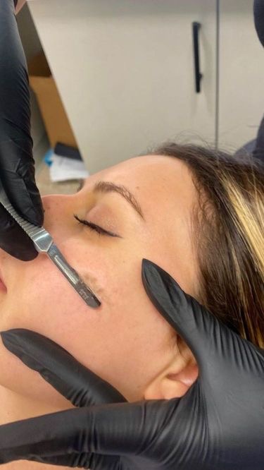 Dermaplaning Treatment