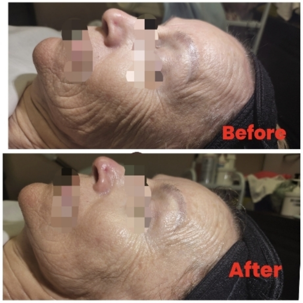 Hifu Treatment (Face) at Sun Skincare LLC in Scottsdale, AZ