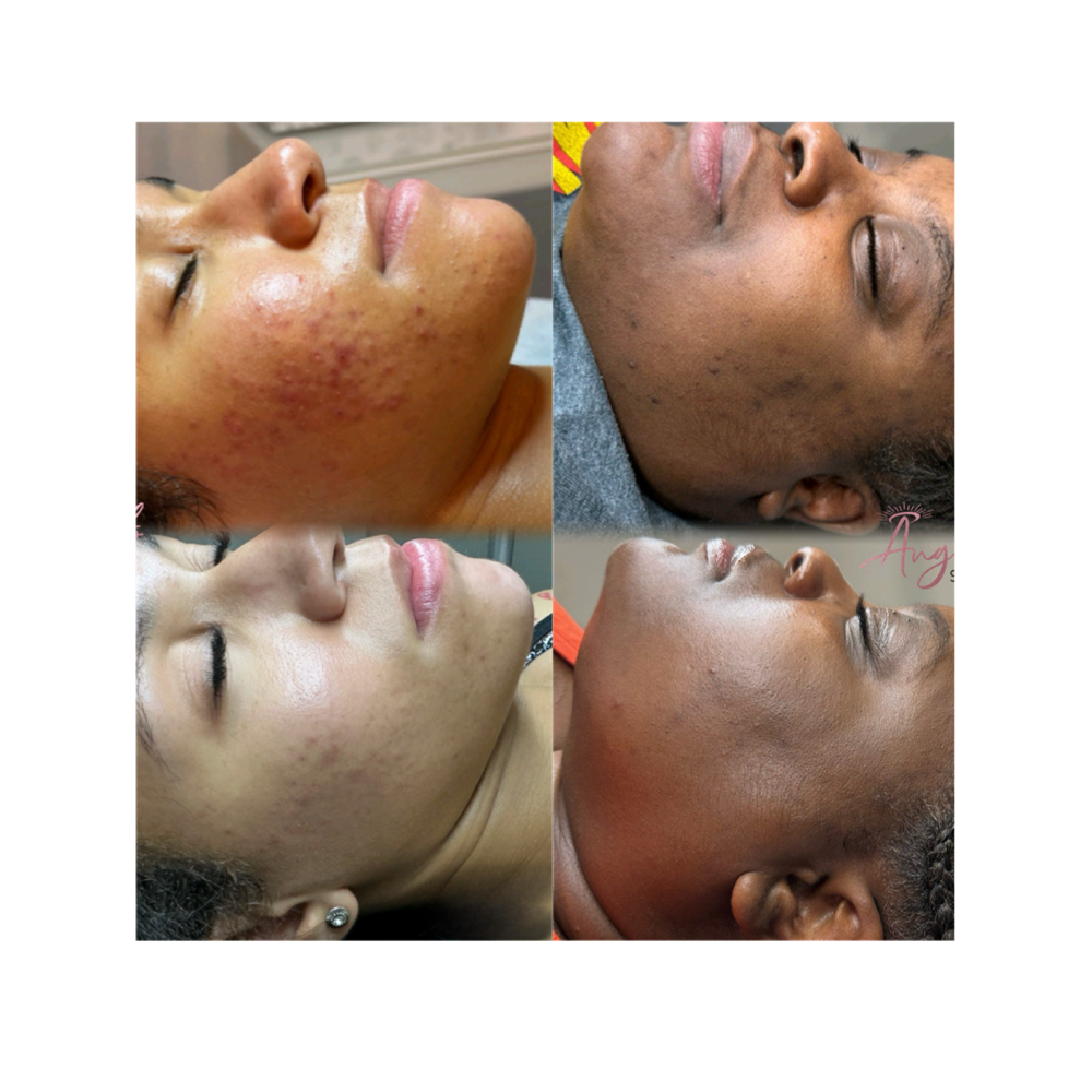 Acne Free Club~4-6 Week Maintenace