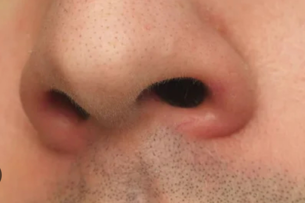 Nose hair removal