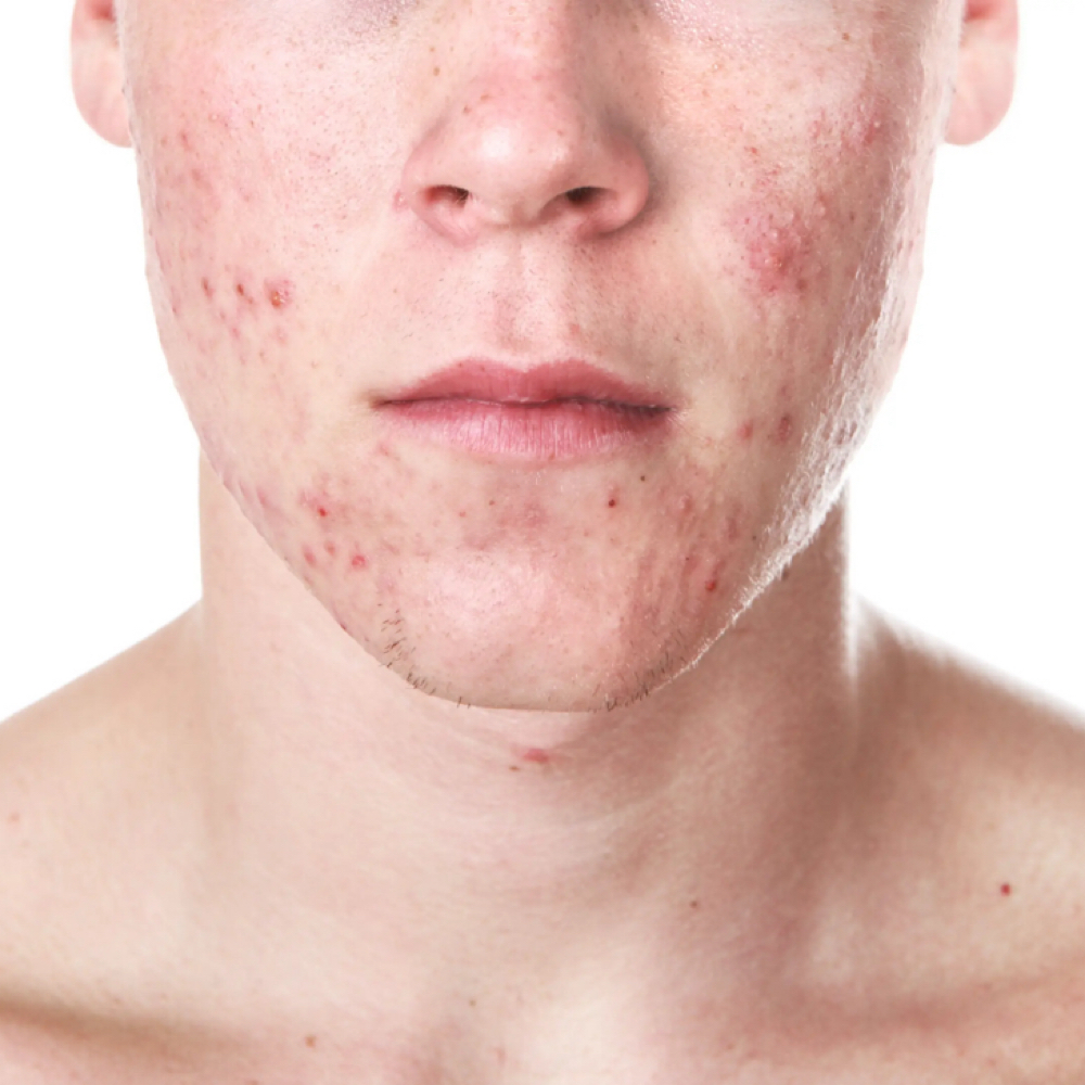 Acne Bootcamp at Skin by Cydni in Atlanta, GA
