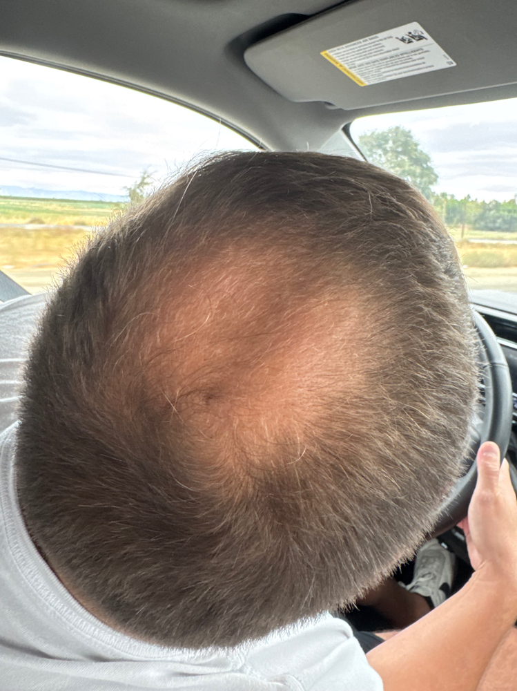 SMP Crown Thinning Men & Women