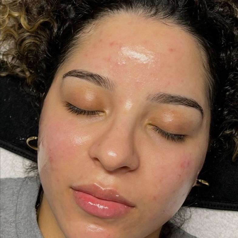 Acne/Oily Facial at HALO SKN ESTHETICS in Killeen, TX