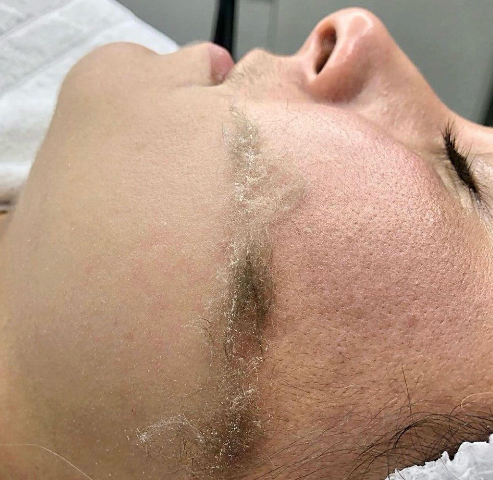 Dermaplening Facial