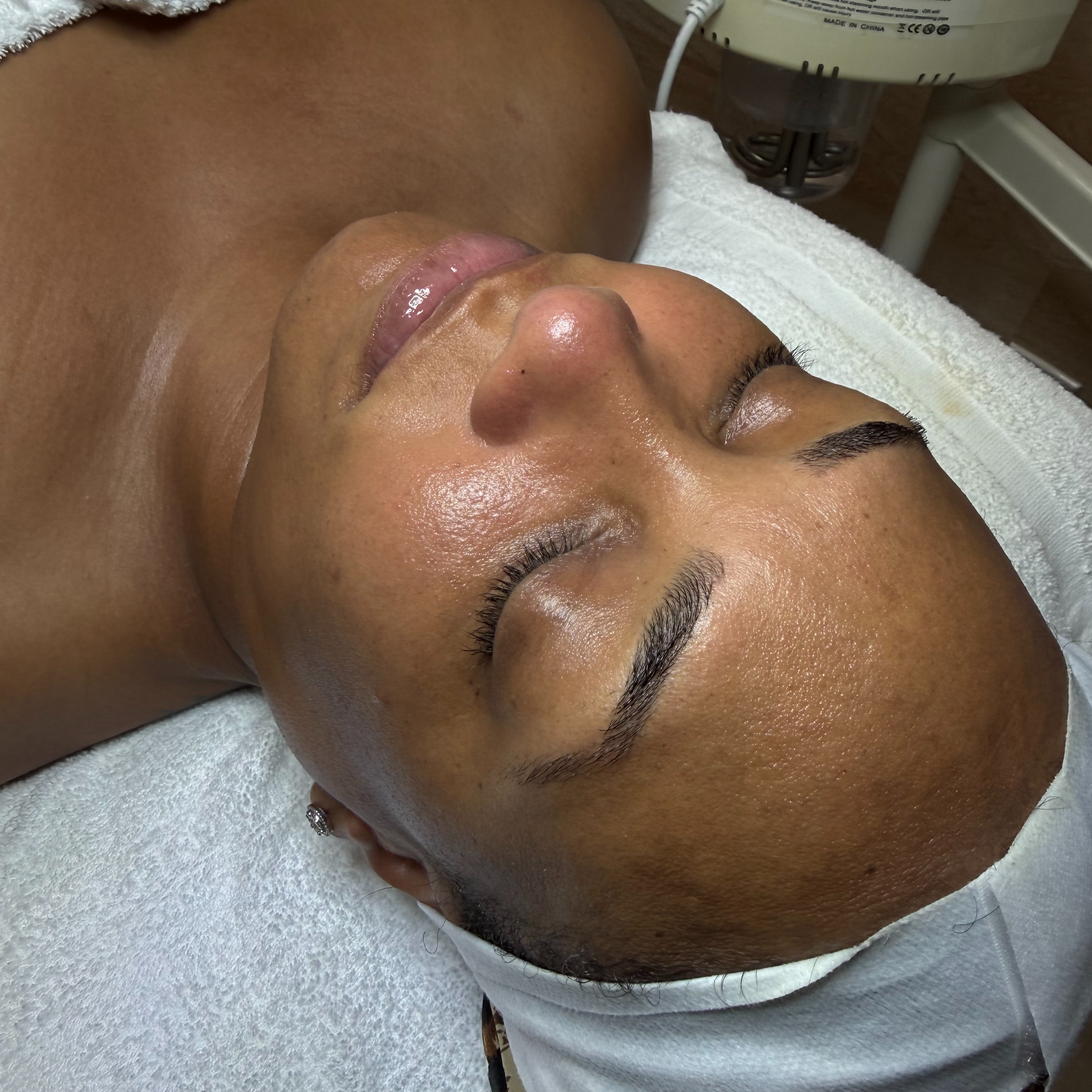 Level 2 Corrective Treatment at Velnaira in Lakewood, CA