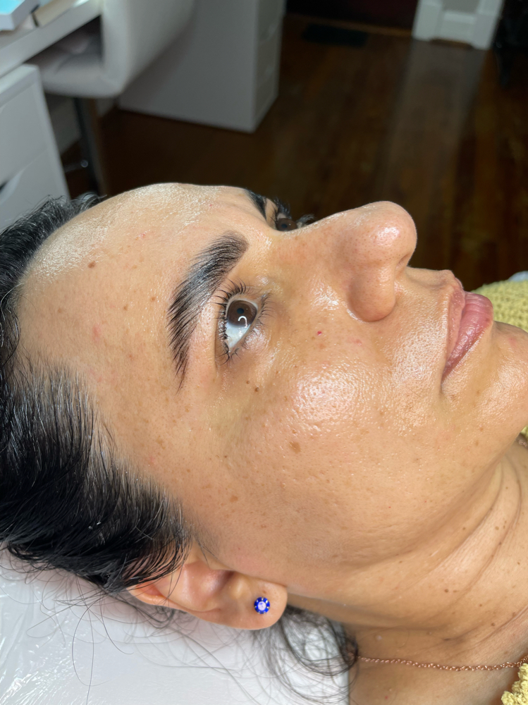 DERMAPLANING