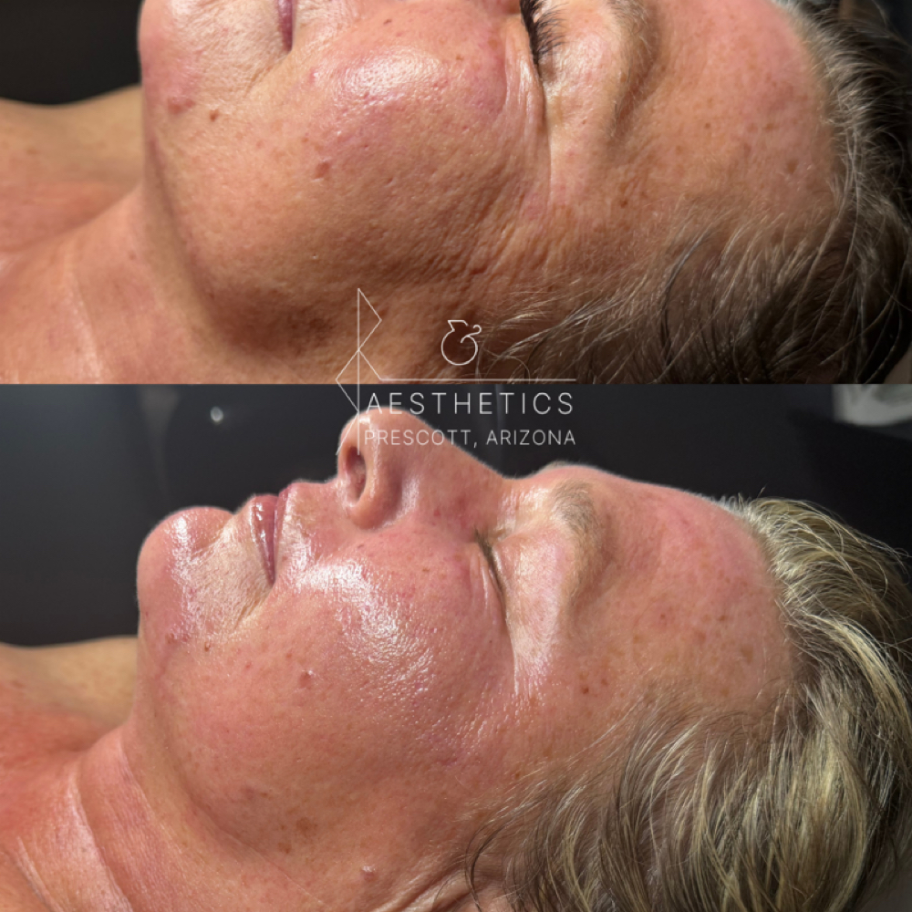 Liquid Microneedling (Green Power) at R&R Aesthetics - Prescott, Arizona in Prescott, AZ