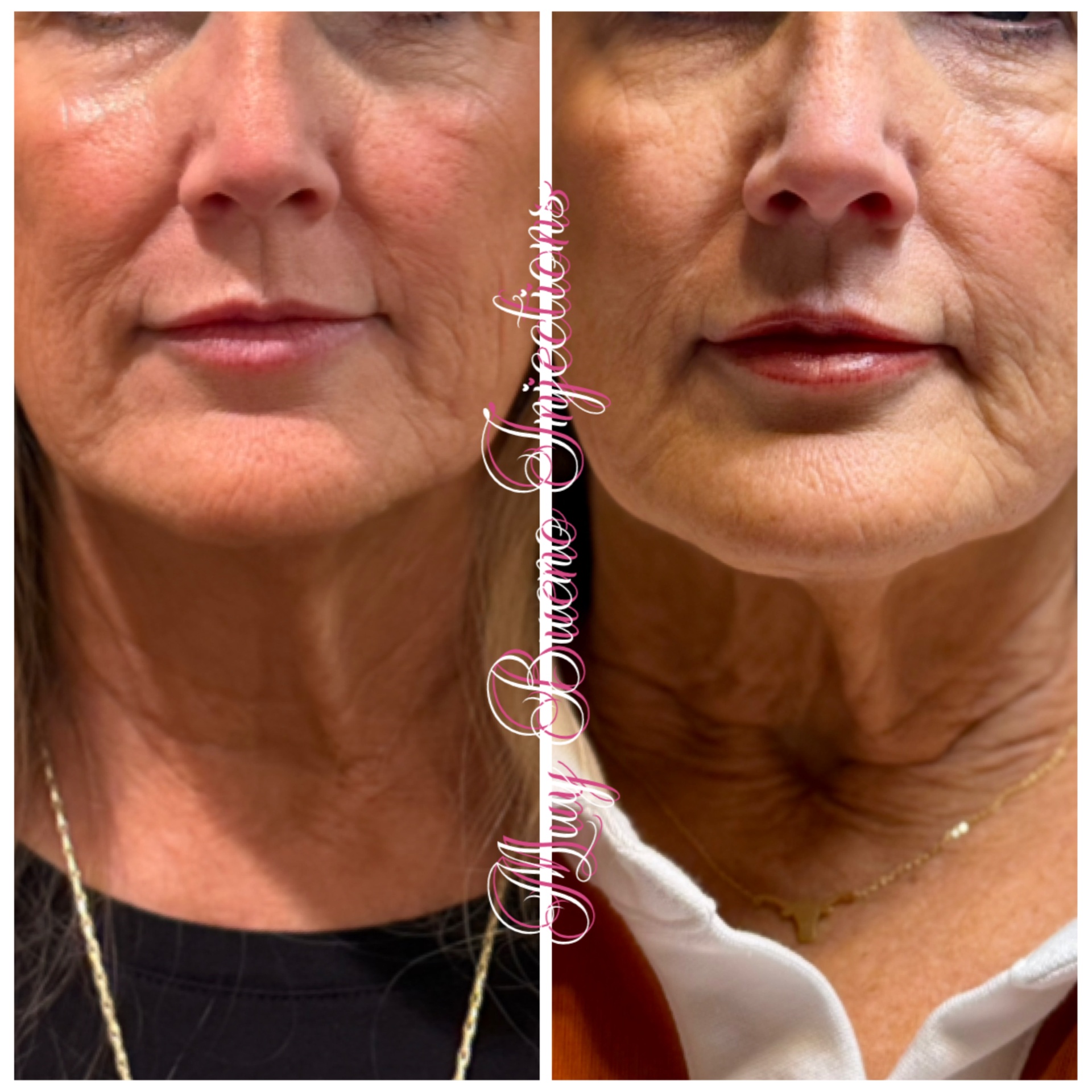Facial Balancing at Muy Bueno Injections by Pat MSN RN in San Antonio, TX