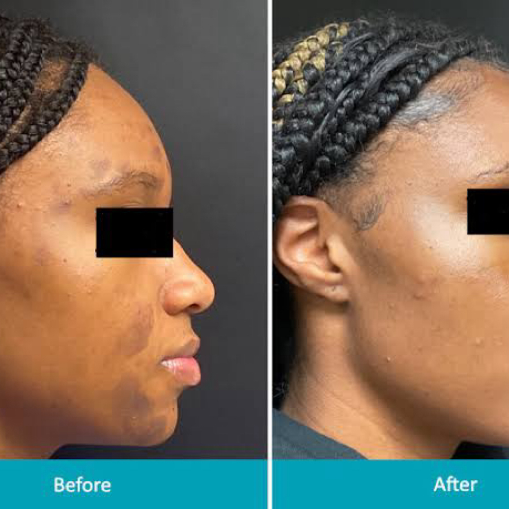 TCA  Peel (Acne/Discoloration) at Cam Cosmetics in Chicago, IL