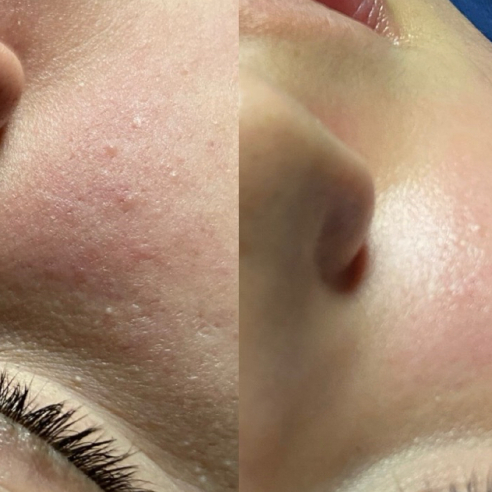 Dermaplane Facial at Bella By Magali in Rogers, AR