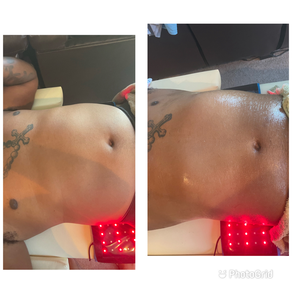 Radio Frequency Skin Tightening