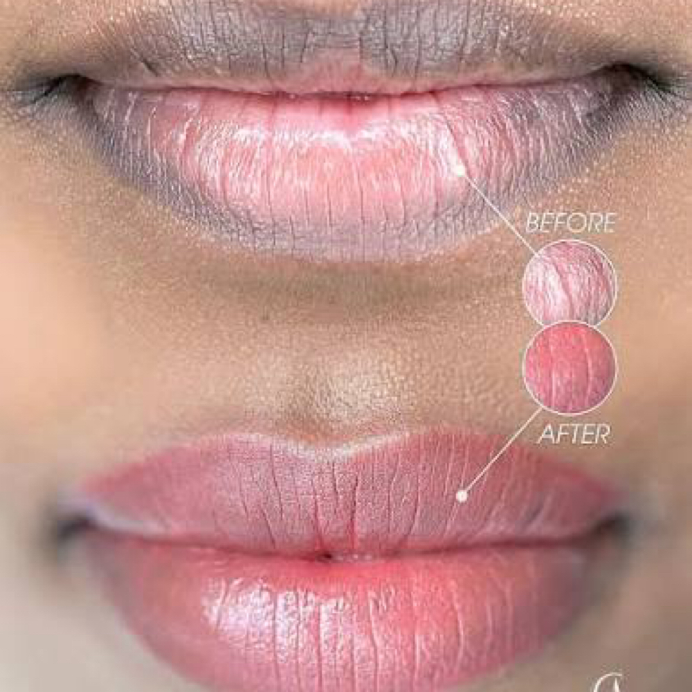 LIPS NEUTRALIZATION (1st SESSION ) at BEAUYBYJOJO PMU STUDIO in Plainfield, IL