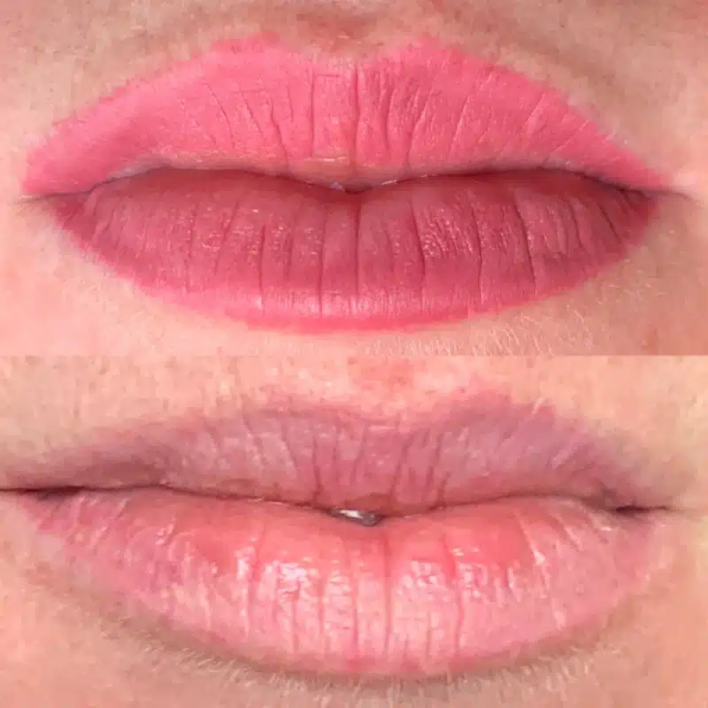 Laser PMU Removal- Lips at Meraki Artistry in Greenwood, IN