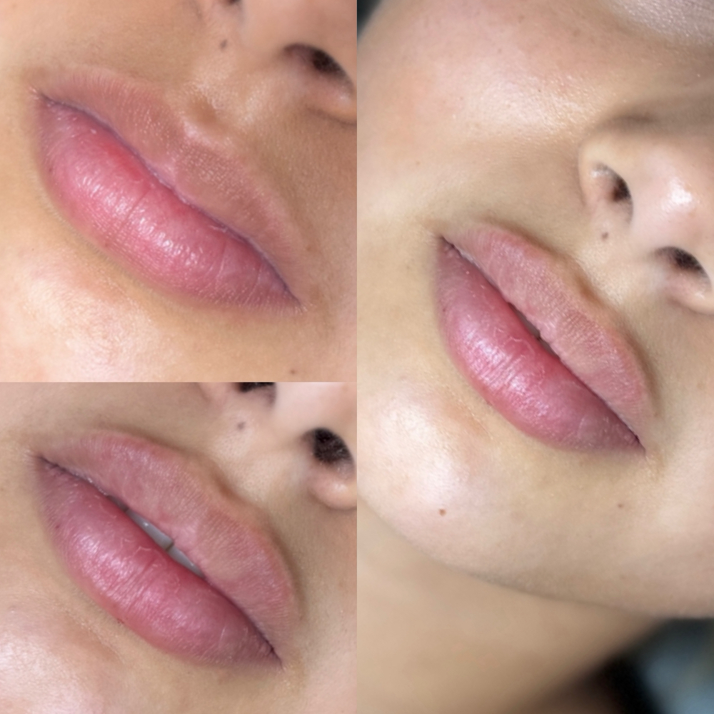 $290 Lip Filler Model For Training at Spa Lina by injectorsamm in San Antonio, TX