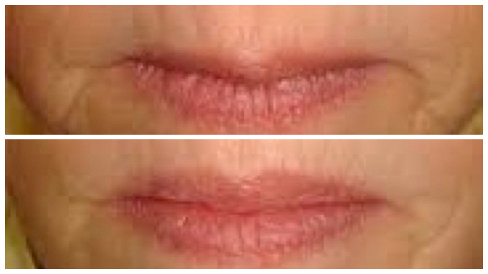 Lip Restoration