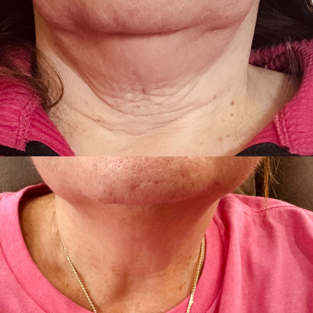 Lipo Dissolve (PCDC) at Aesthetic Beauty Bar, LLC By Haley in Tyler, TX