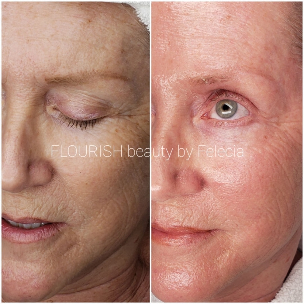 Sculplla Filler Facial