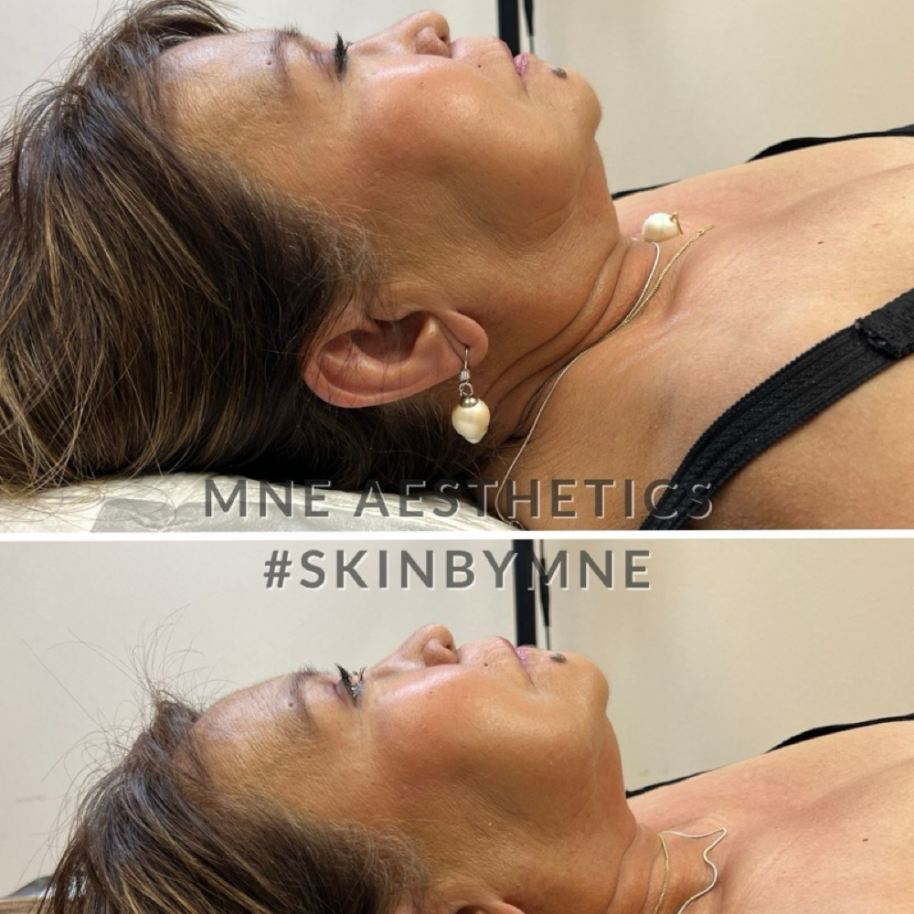 Double Chin Treatment at Mne Aesthetics in Missouri City, TX
