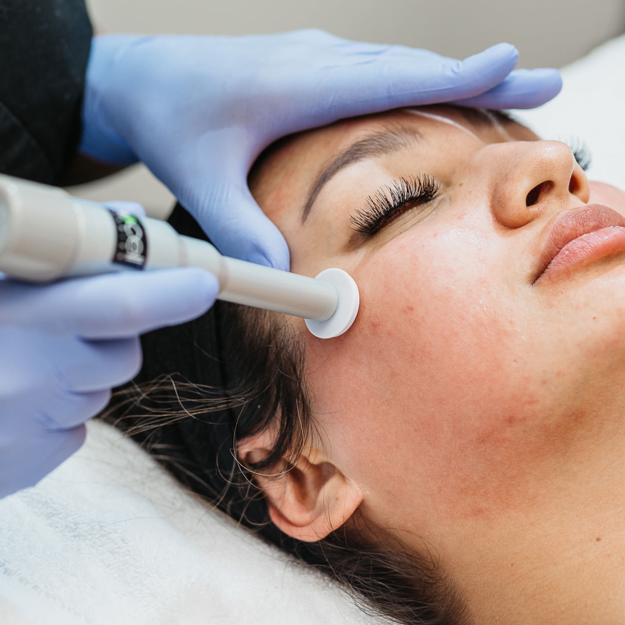 Microneedling at SoLuna Aesthetics in Scottsdale, AZ