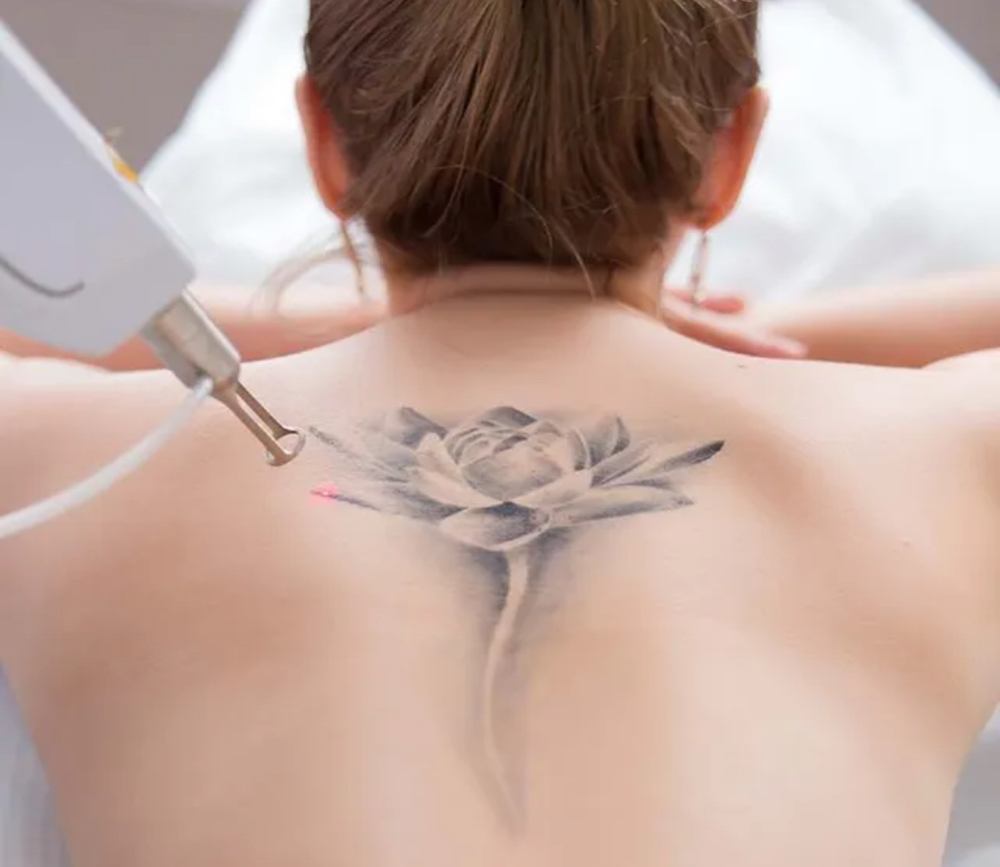 Laser Tatto Removal  - Medium at Selflovebyely in Ocala, FL
