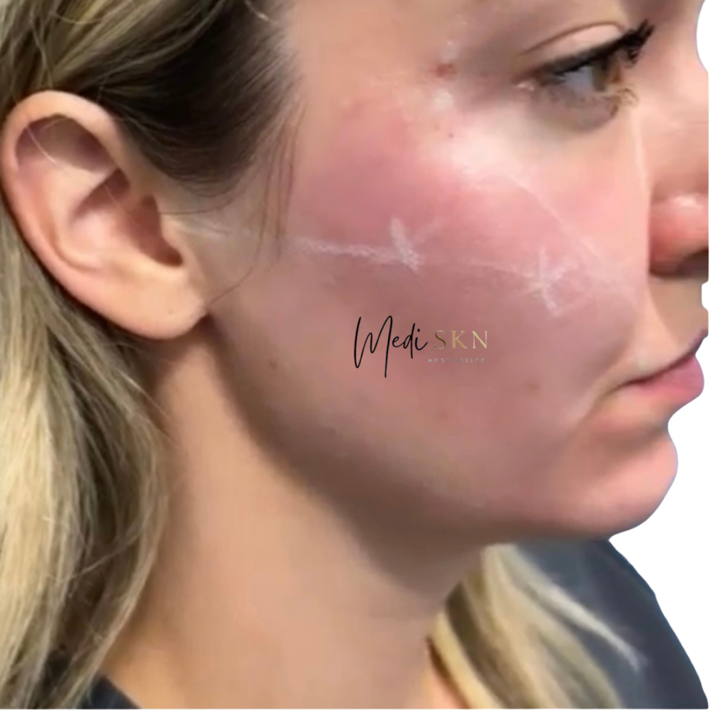 Cheek Filler