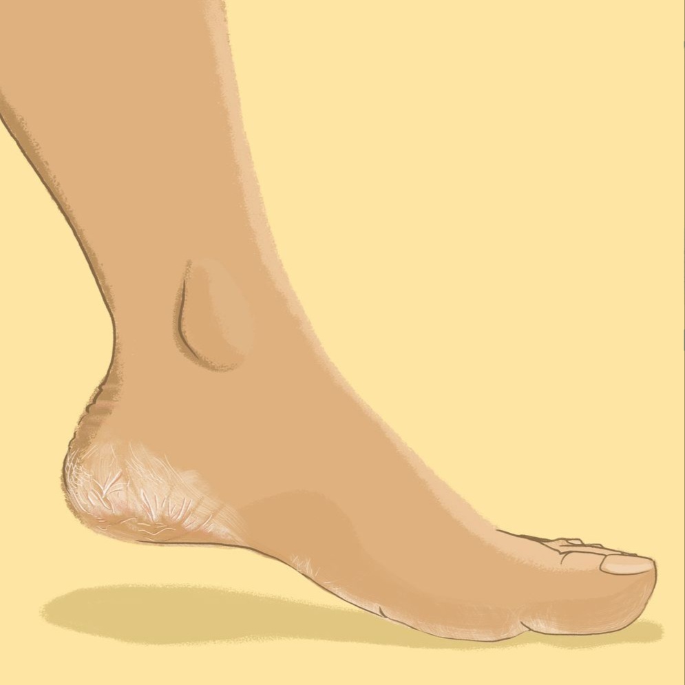 Cracked Heel Repair Treatment at Poppy & Pine Hair Co. in Chico, CA