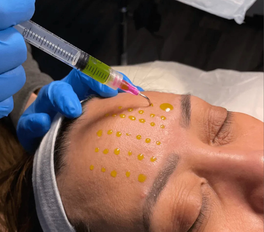 Customized Chemical Peel