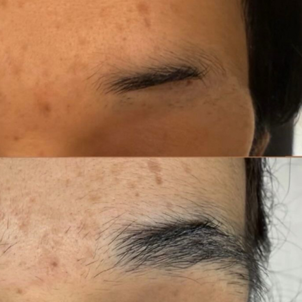 Follicure Per Session at Body Contouring & More in Modesto, CA