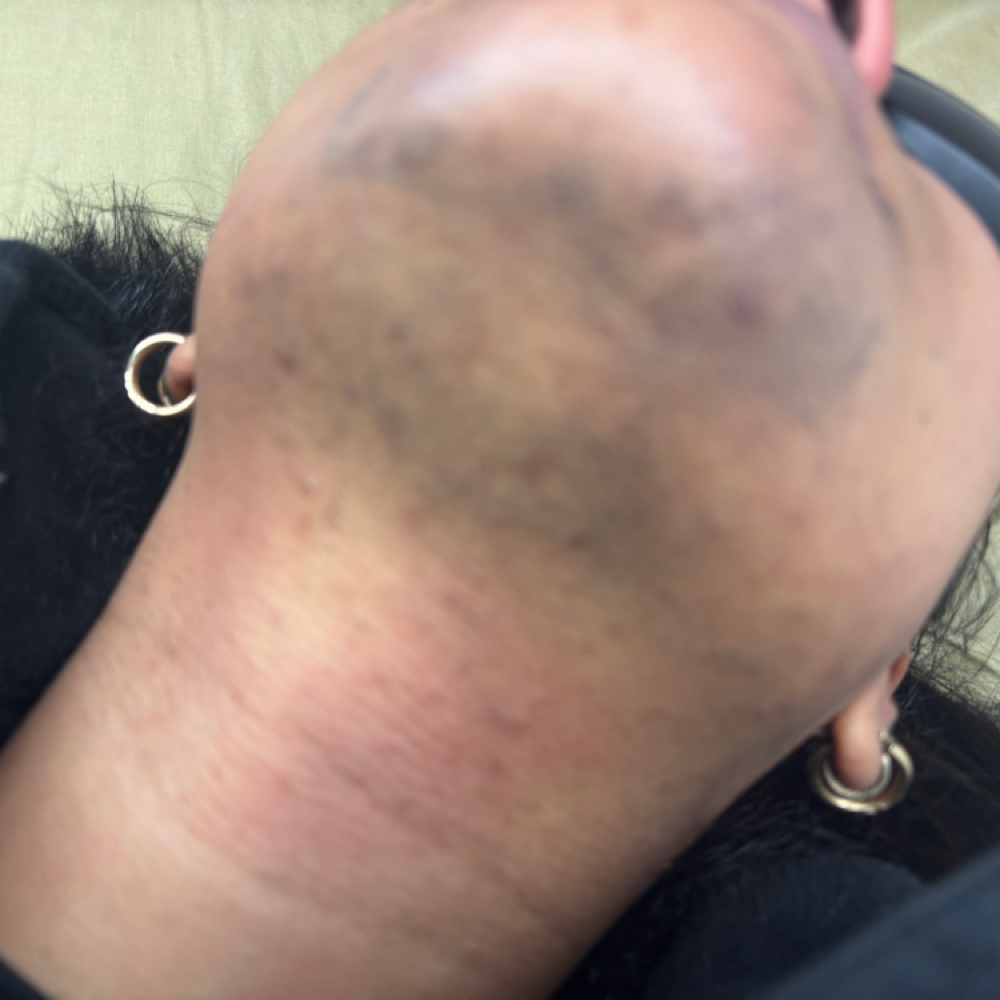 Neck Laser Hair Removal – Single Se at Aestheticbylola in Bronx, NY