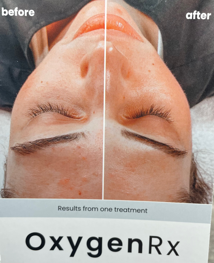 Acne Oxygen Rx Facial at Atypical Beauty in Brookings, OR