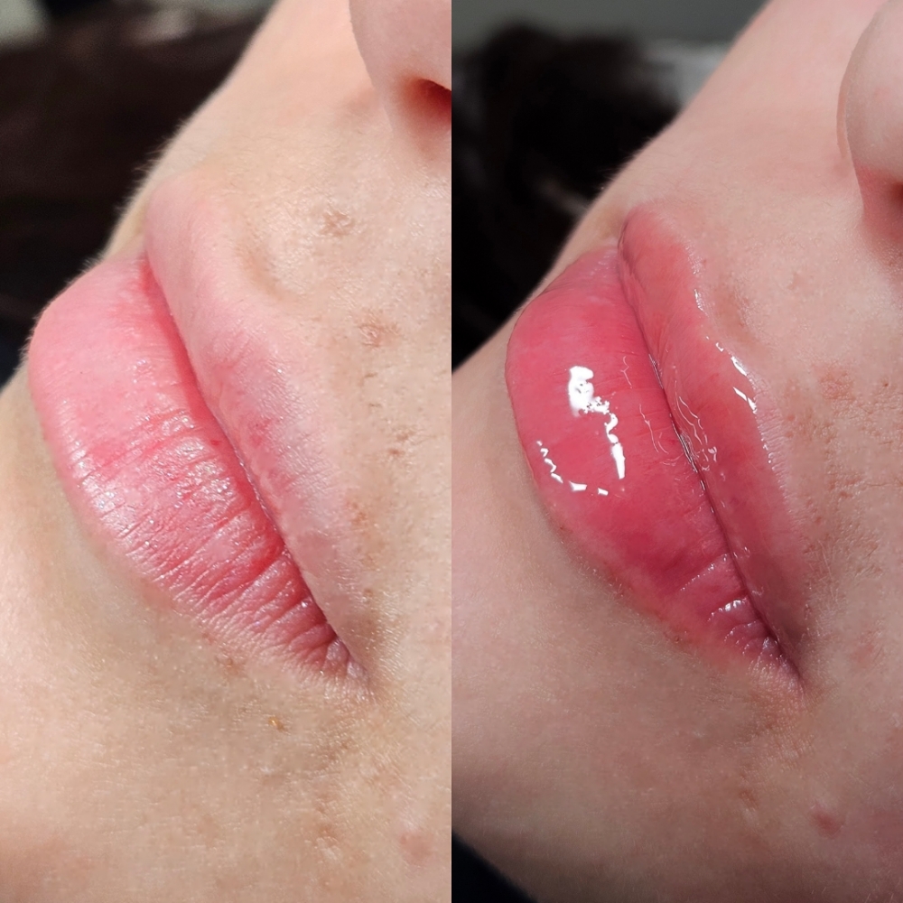 Hydra Lips 1 Session