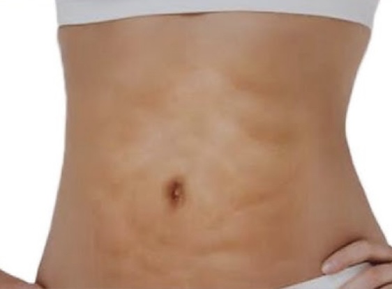 FibroFix Recovery