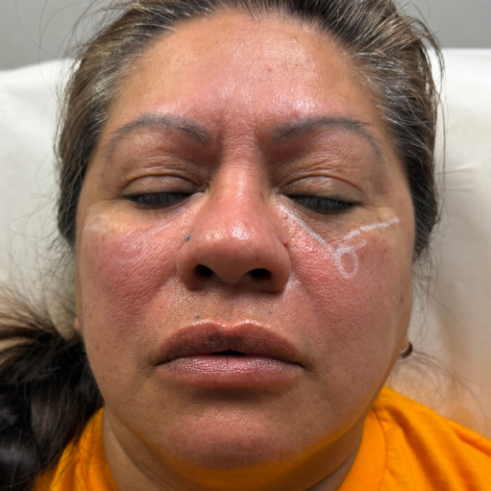 PRF EZ Gel at Atelier Aesthetics and Infusions in Dallas, TX