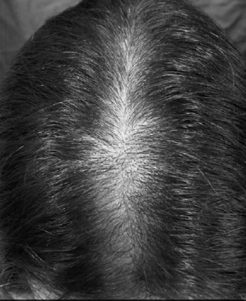 Microneedling/Scalp For Hair Growth