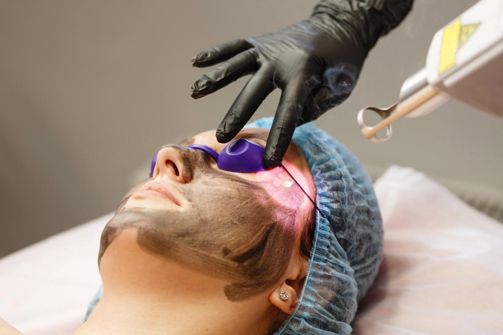 Carbon Laser Peel