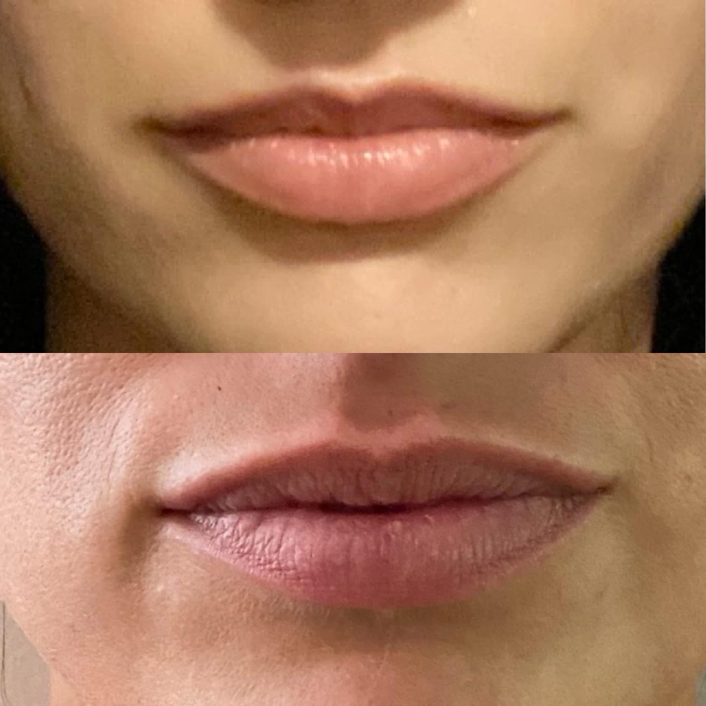 Lip Flip at Candice Stacy in Gilbert, WV