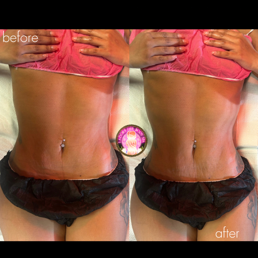 Post Op Lymph Massage & Post Cavi